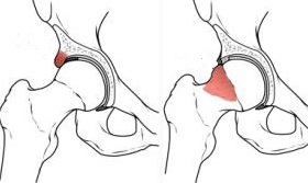 Osteosarcoma femore